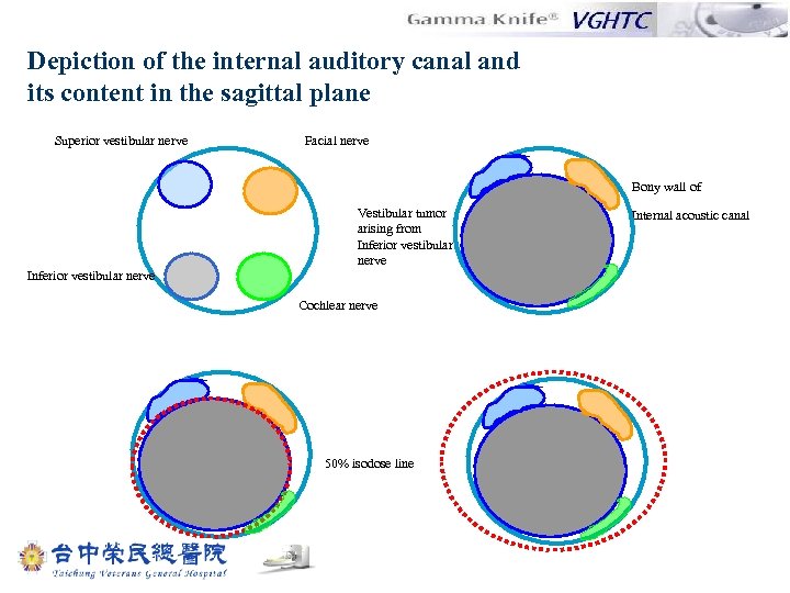 Depiction of the internal auditory canal and its content in the sagittal plane Superior