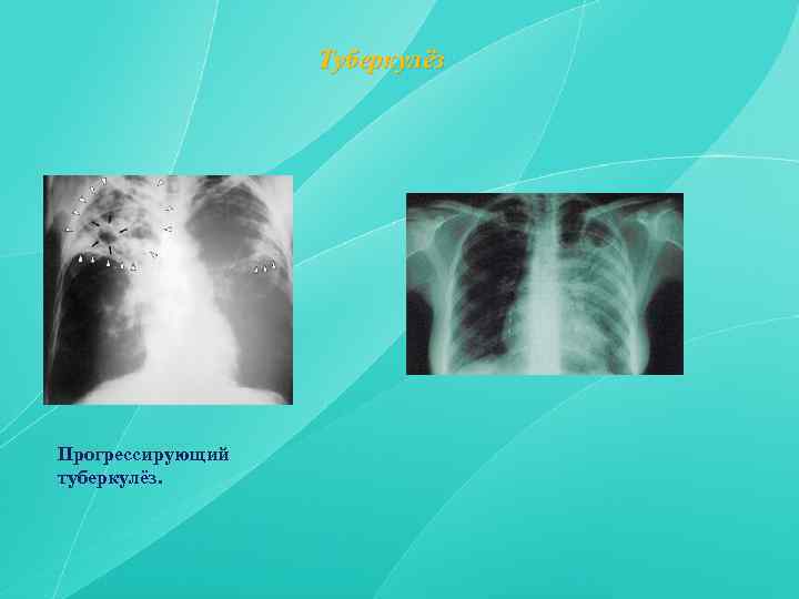 Смешанная форма прогрессирования туберкулеза. Смешанное прогрессирования туберкулез морфология.