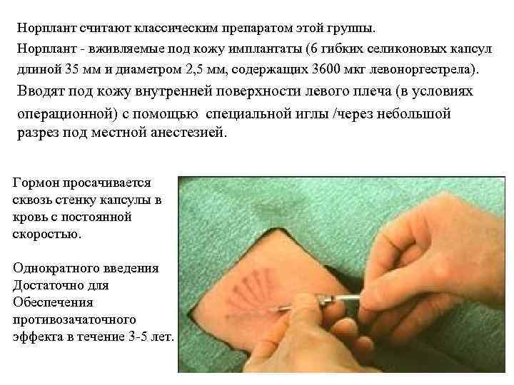 Норплант считают классическим препаратом этой группы. Норплант - вживляемые под кожу имплантаты (6 гибких