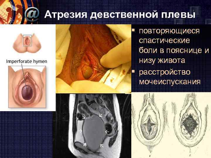 Атрезия девственной плевы § повторяющиеся спастические боли в пояснице и низу живота § расстройство