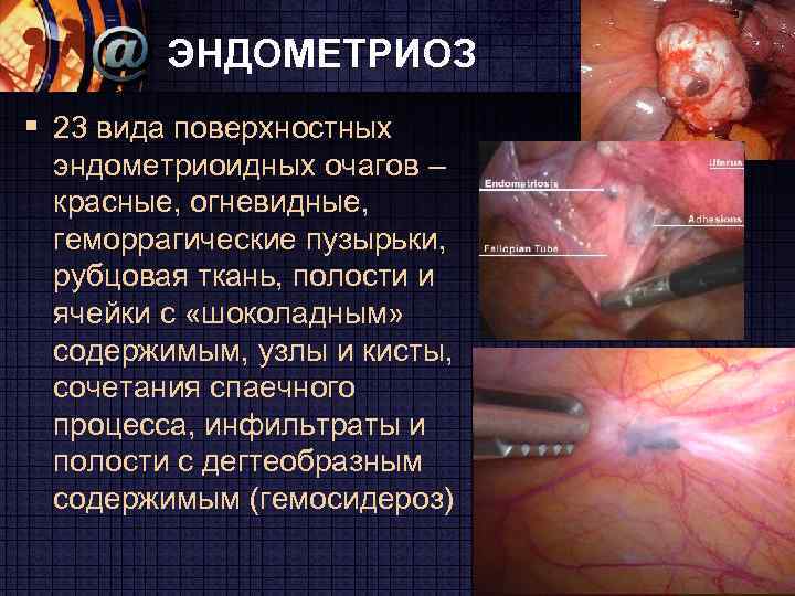 ЭНДОМЕТРИОЗ § 23 вида поверхностных эндометриоидных очагов – красные, огневидные, геморрагические пузырьки, рубцовая ткань,