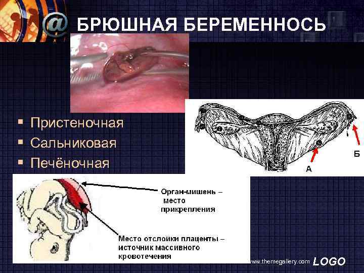 БРЮШНАЯ БЕРЕМЕННОСЬ § Пристеночная § Сальниковая § Печёночная www. themegallery. com LOGO 