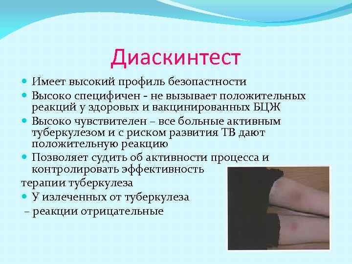 Диаскинтест Имеет высокий профиль безопастности Высоко специфичен - не вызывает положительных реакций у здоровых