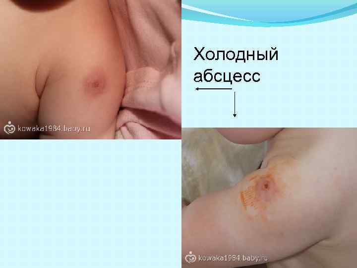 Холодный абсцесс 