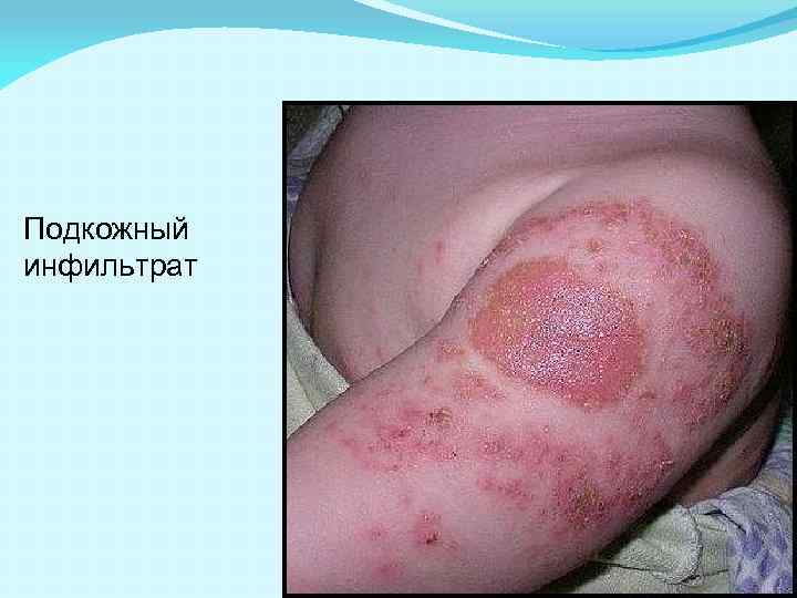 Подкожный инфильтрат 