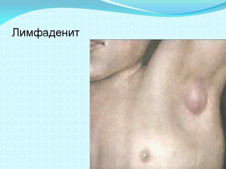 Лимфаденит 