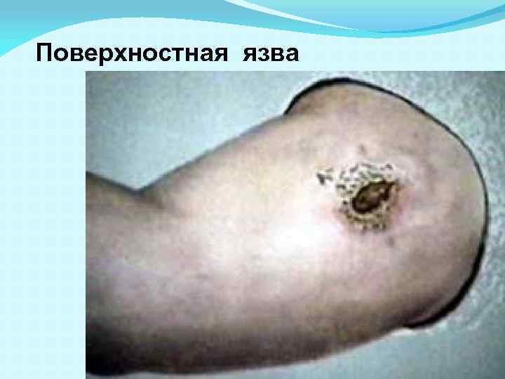 Поверхностная язва 