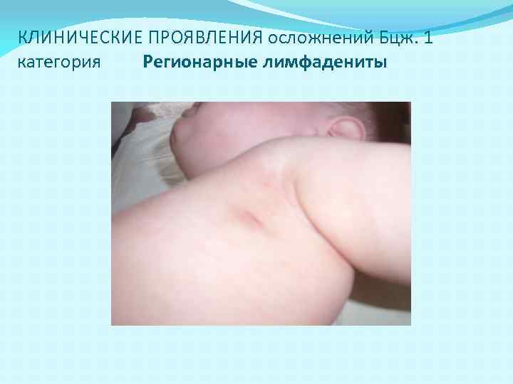 КЛИНИЧЕСКИЕ ПРОЯВЛЕНИЯ осложнений Бцж. 1 категория Регионарные лимфадениты 