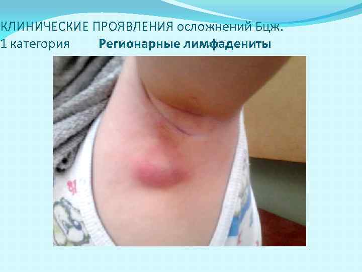 КЛИНИЧЕСКИЕ ПРОЯВЛЕНИЯ осложнений Бцж. 1 категория Регионарные лимфадениты 