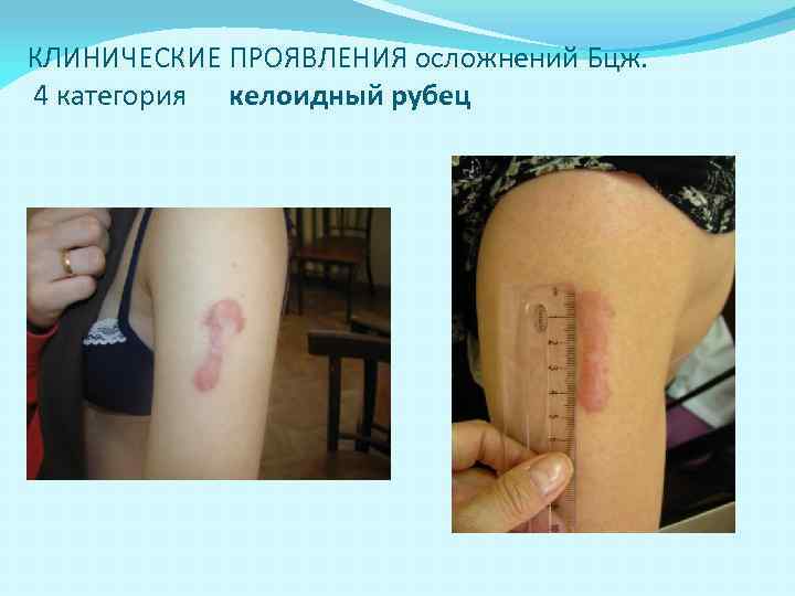 КЛИНИЧЕСКИЕ ПРОЯВЛЕНИЯ осложнений Бцж. 4 категория келоидный рубец 
