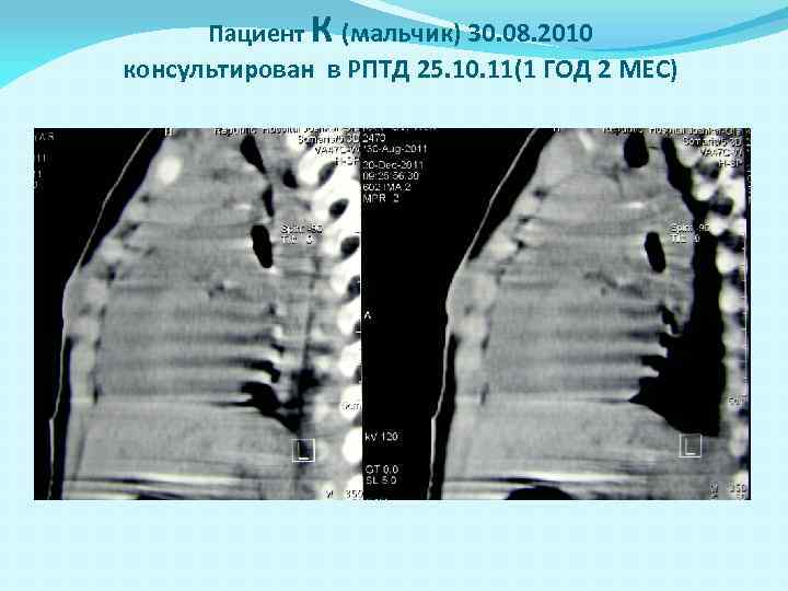 Пациент К (мальчик) 30. 08. 2010 консультирован в РПТД 25. 10. 11(1 ГОД 2