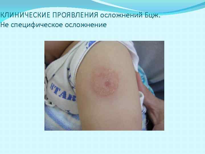 КЛИНИЧЕСКИЕ ПРОЯВЛЕНИЯ осложнений Бцж. Не специфическое осложнение 