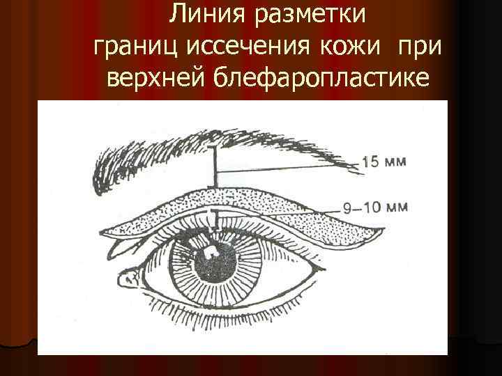Линия разметки границ иссечения кожи при верхней блефаропластике 