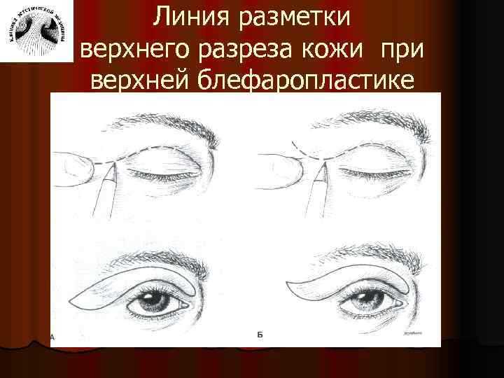 Линия разметки верхнего разреза кожи при верхней блефаропластике 