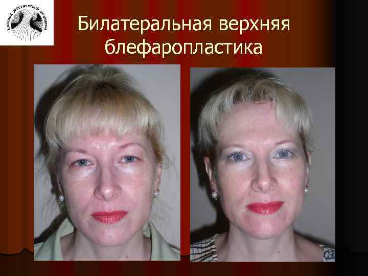 Билатеральная верхняя блефаропластика 