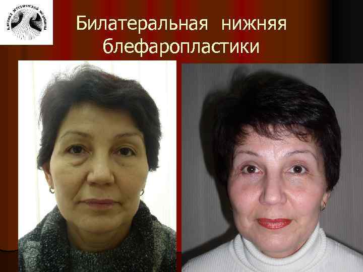 Билатеральная нижняя блефаропластики 