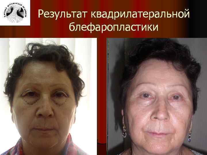 Результат квадрилатеральной блефаропластики 
