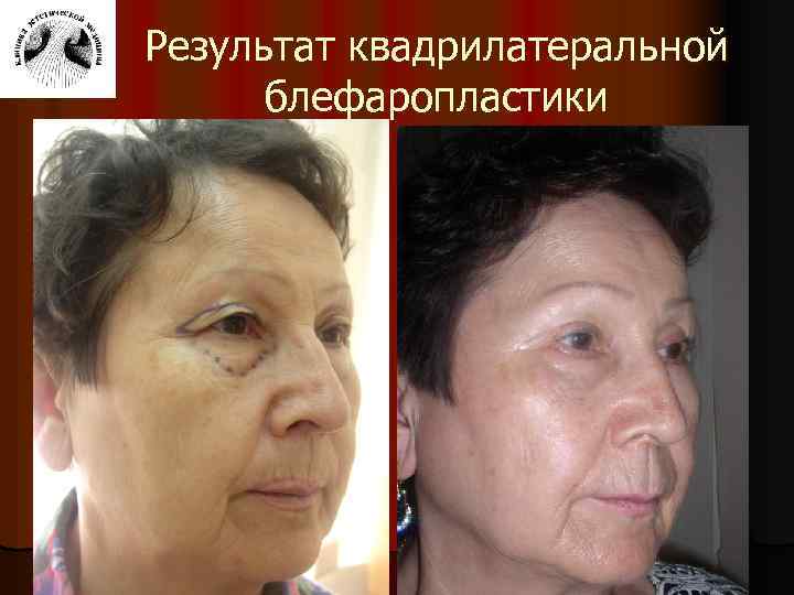 Результат квадрилатеральной блефаропластики 