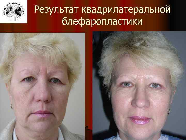 Результат квадрилатеральной блефаропластики 