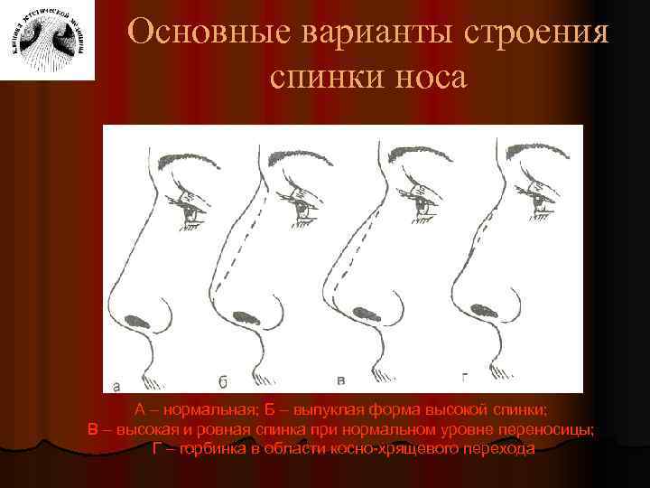 Основные варианты строения спинки носа А – нормальная; Б – выпуклая форма высокой спинки;