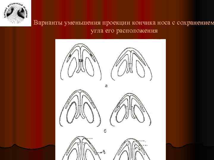 Варианты уменьшения проекции кончика носа с сохранением угла его расположения 