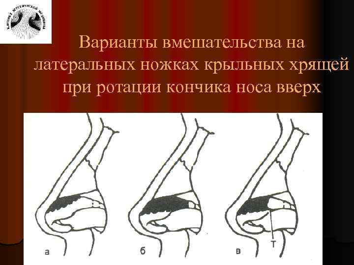 Варианты вмешательства на латеральных ножках крыльных хрящей при ротации кончика носа вверх 