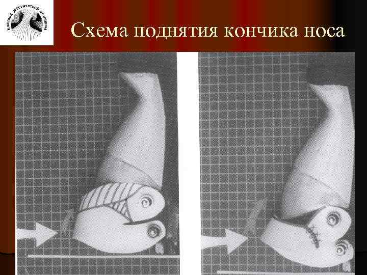Схема поднятия кончика носа 