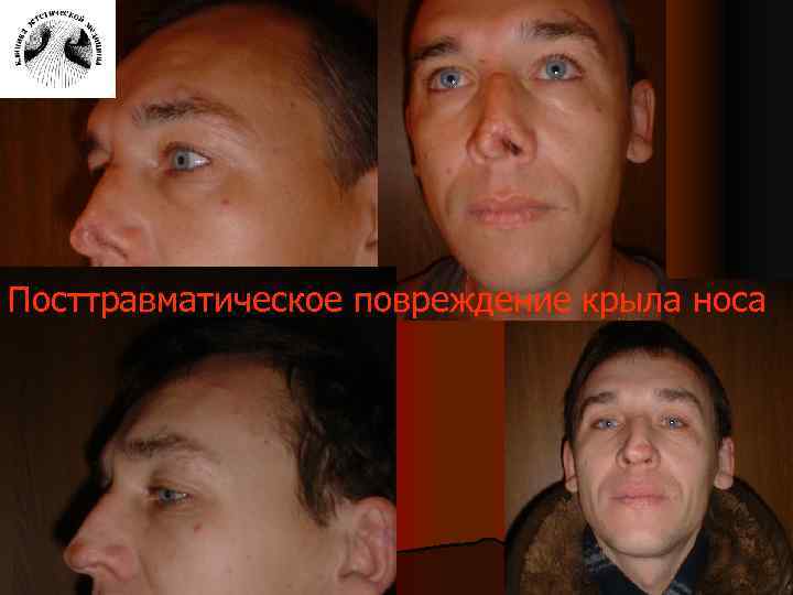 Посттравматическое повреждение крыла носа 