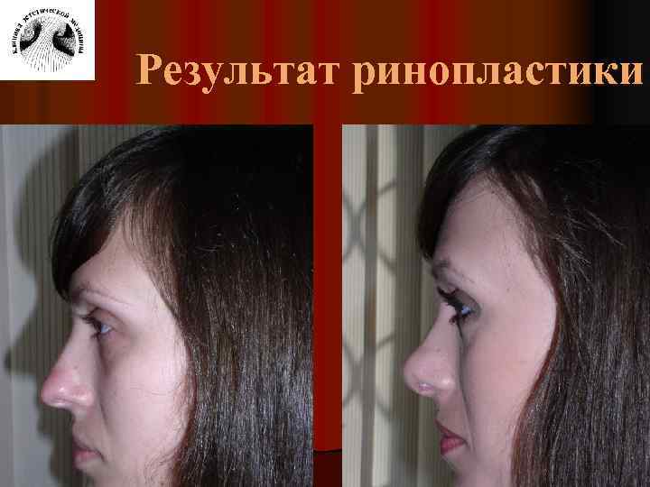 Результат ринопластики 