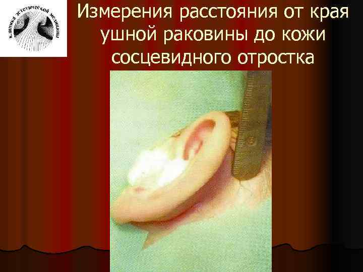 Измерения расстояния от края ушной раковины до кожи сосцевидного отростка 
