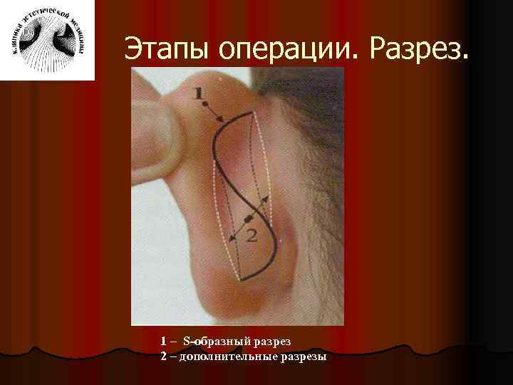 Этапы операции. Разрез. 1 – S-образный разрез 2 – дополнительные разрезы 