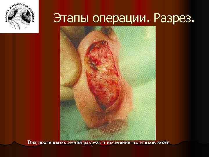 Этапы операции. Разрез. Вид после выполнения разреза и иссечения излишков кожи 