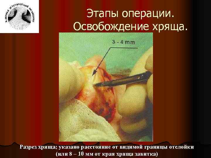 Этапы операции. Освобождение хряща. Разрез хряща; указано расстояние от видимой границы отслойки (или 8