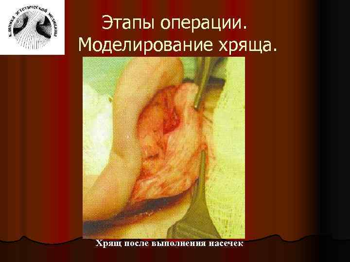 Этапы операции. Моделирование хряща. Хрящ после выполнения насечек 