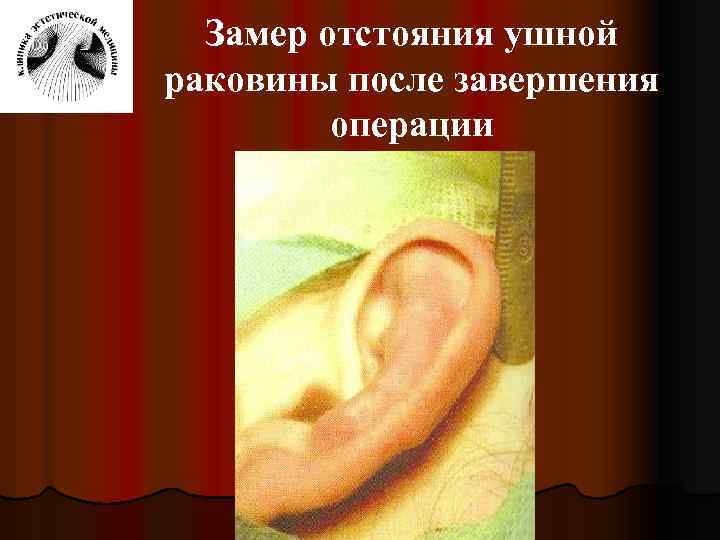 Замер отстояния ушной раковины после завершения операции 