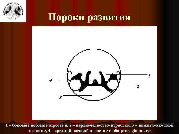 Пороки развития 1 – боковые носовые отростки, 2 – верхнечелюстые отростки, 3 – нижнечелюстной