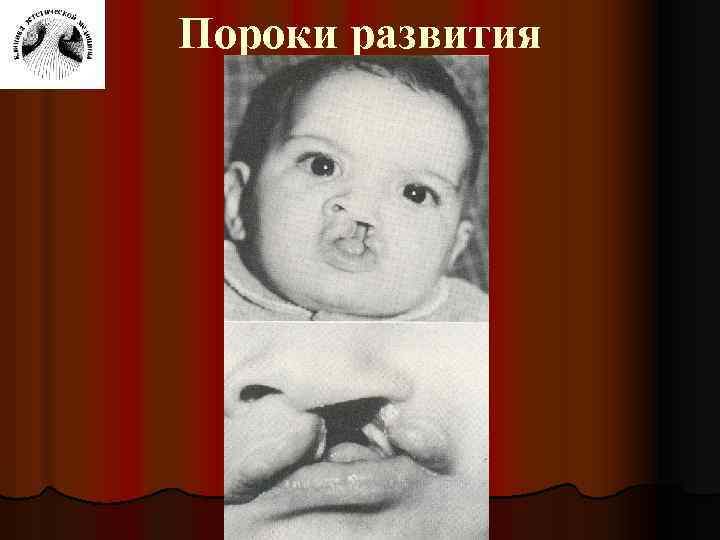 Пороки развития 