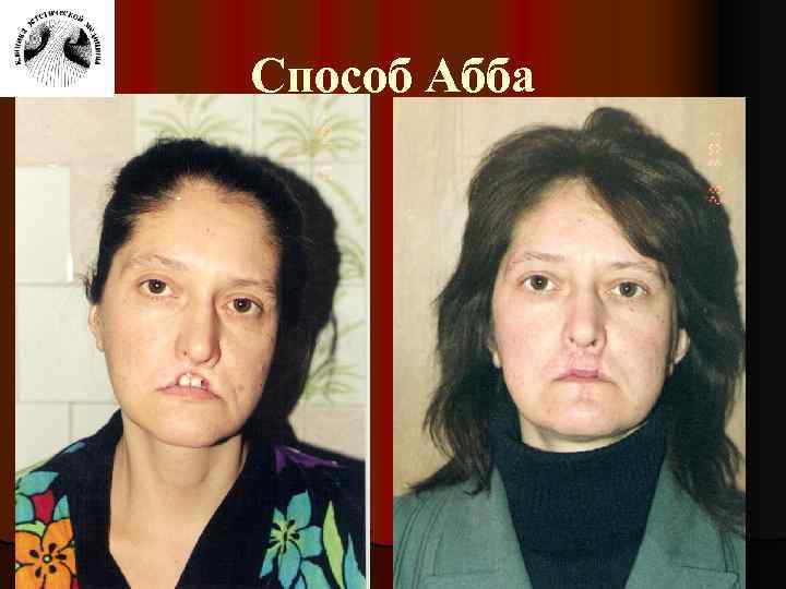 Способ Абба 