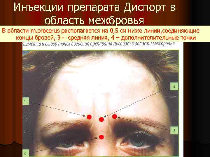 Инъекции препарата Диспорт в область межбровья В области m. procerus располагается на 0, 5