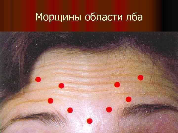 Морщины области лба 