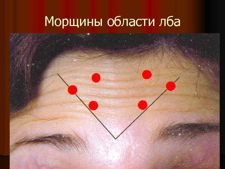 Морщины области лба 