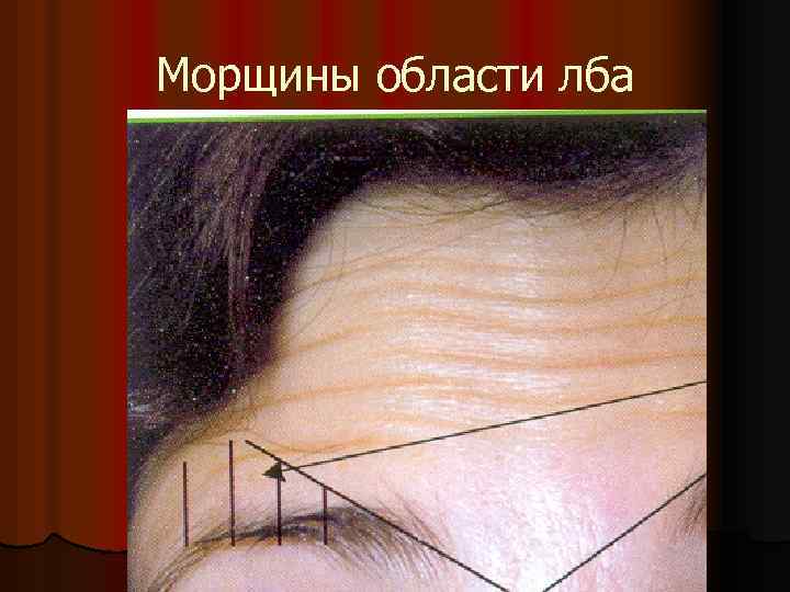 Морщины области лба 