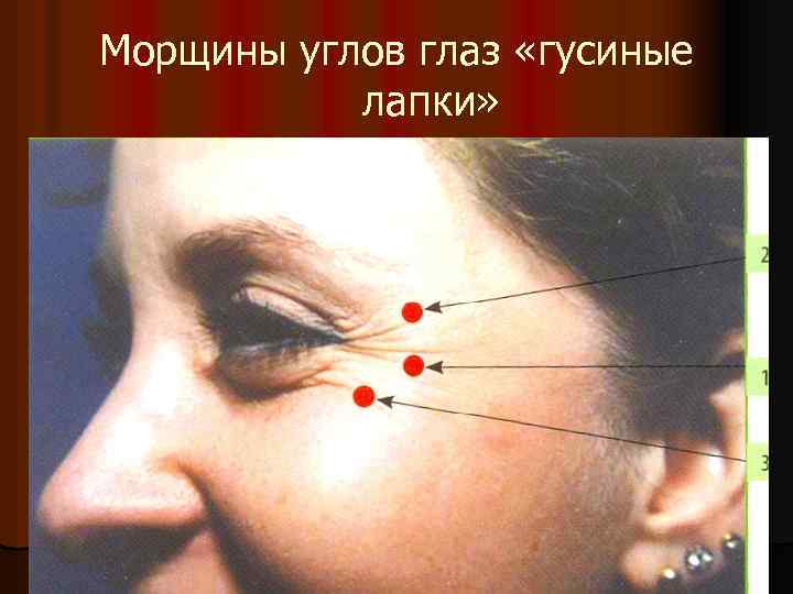 Морщины углов глаз «гусиные лапки» 