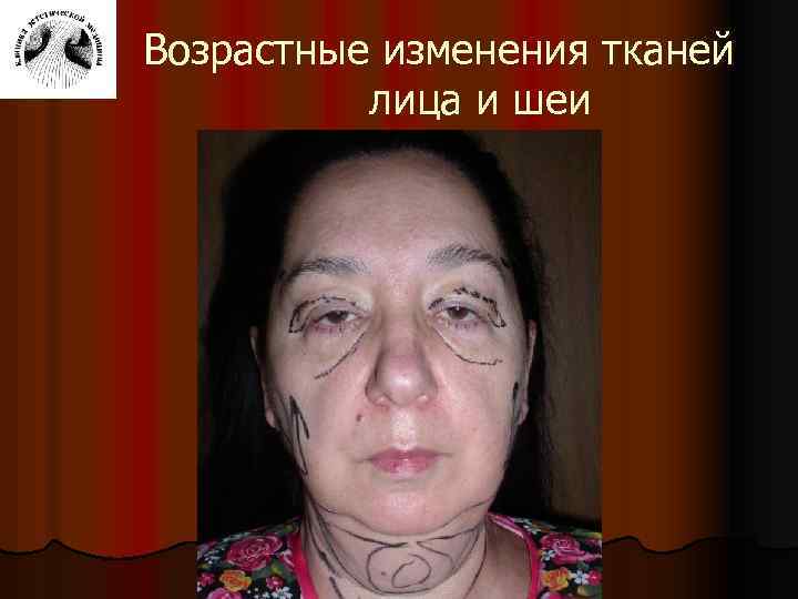 Возрастные изменения тканей лица и шеи 
