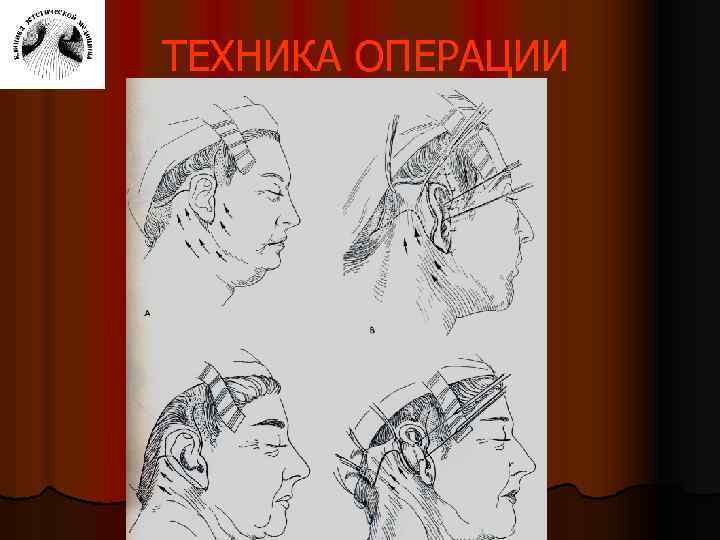 ТЕХНИКА ОПЕРАЦИИ 