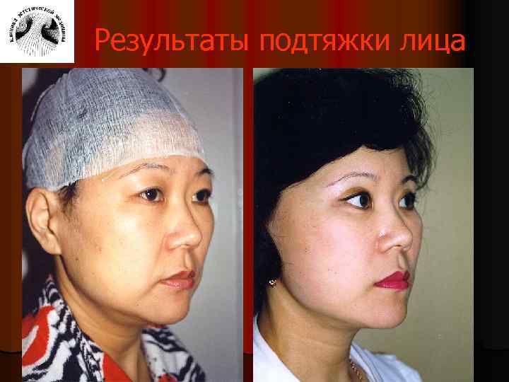 Результаты подтяжки лица 