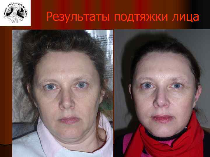 Результаты подтяжки лица 