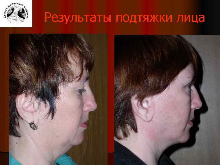 Результаты подтяжки лица 