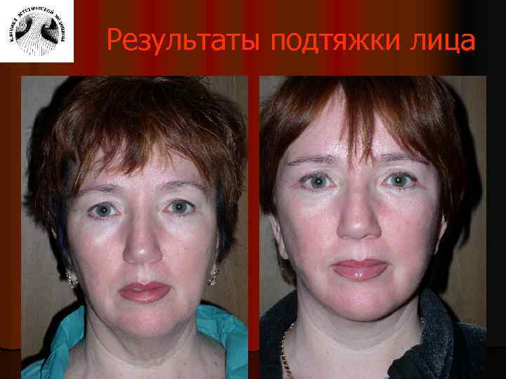 Результаты подтяжки лица 