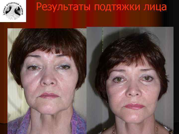 Результаты подтяжки лица 